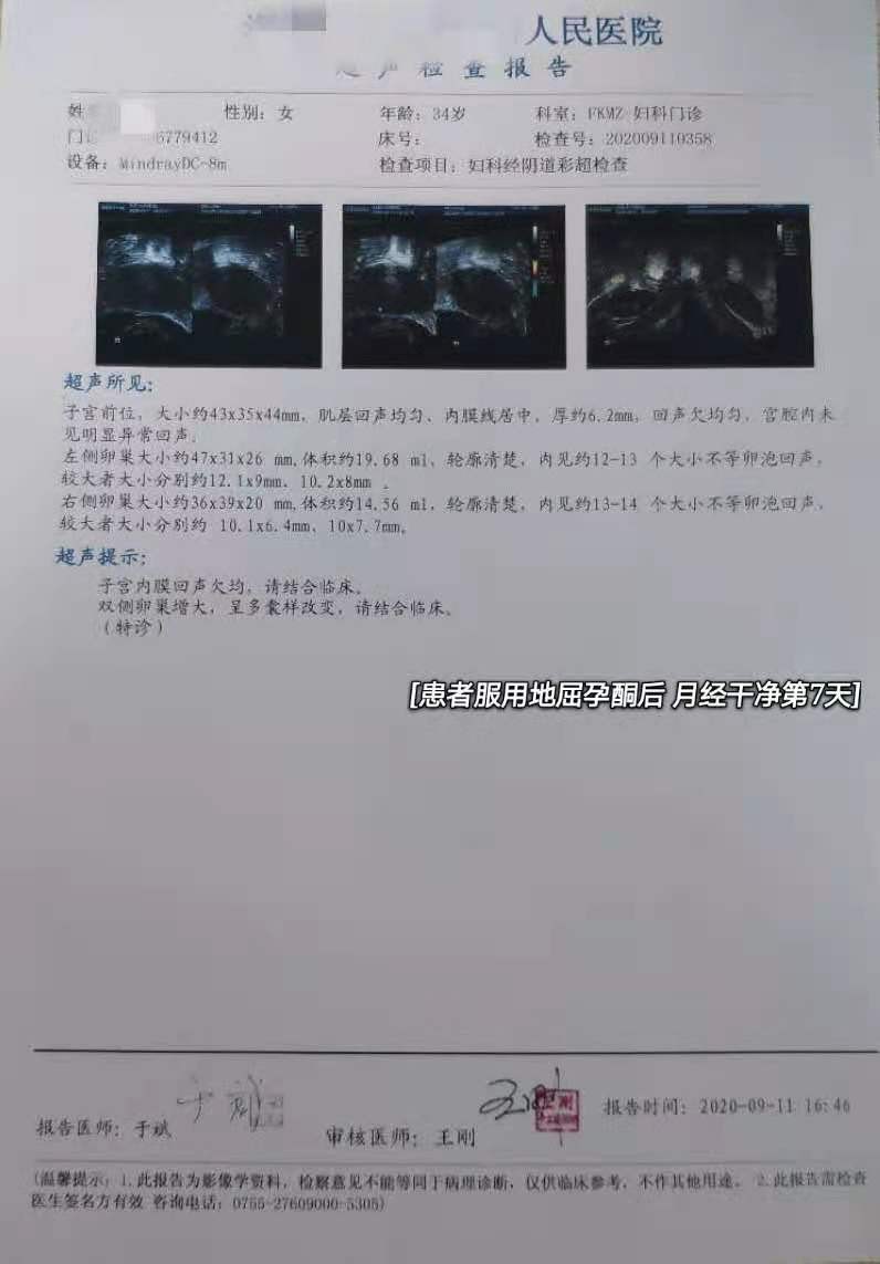 20岁多囊导致闭经,名老中医治多囊卵巢闭经的经验