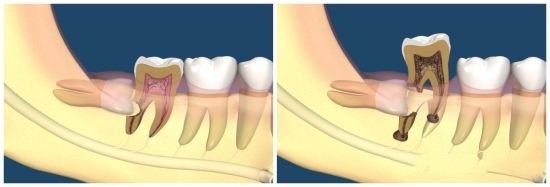 智齿拔牙后一般要痛多久,智齿拔牙不拔牙根会怎样