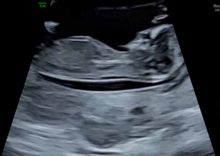 孕期小检查项目,孕期超声检查的那些事