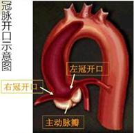 致命的主动脉夹层,主动脉夹层最危险的生命杀手