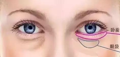 怎么区分眼袋和卧蚕图片女人,眼袋泪沟卧蚕区分图