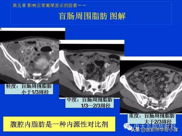 阑尾炎课件,阑尾炎的超声课件