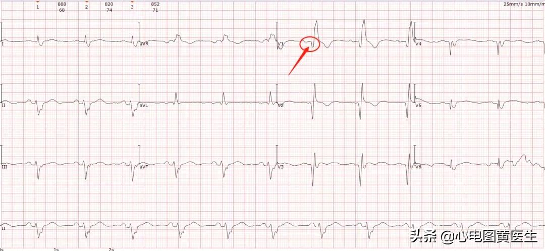 完全性右束支传导阻滞注意什么,完全性右束支传导阻滞如何解决
