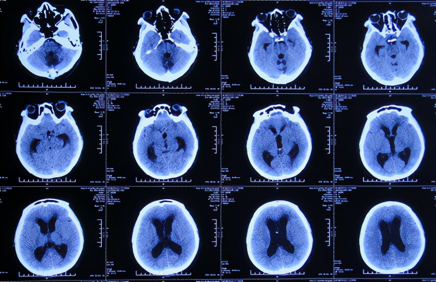 脑出血后脑积水会造成意识不清吗,脑出血后脑积水发高烧危险期多久