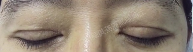 双眼皮失败眼角处有褶皱,双眼皮失败后闭眼痕迹