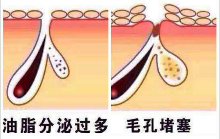 毛囊堵塞导致的脱发怎么办,额头油脂分泌旺盛毛囊堵塞脱发