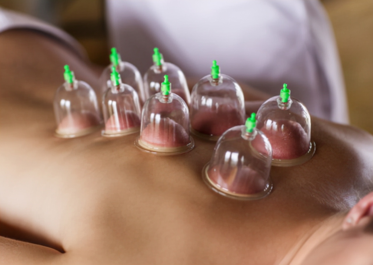 拔火罐时,后背吸出的瘀血是毒素吗?听听医生怎么说