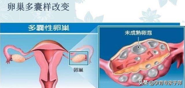 胖多囊和瘦多囊哪个更容易调理,胖多囊怎么减肥吃什么药