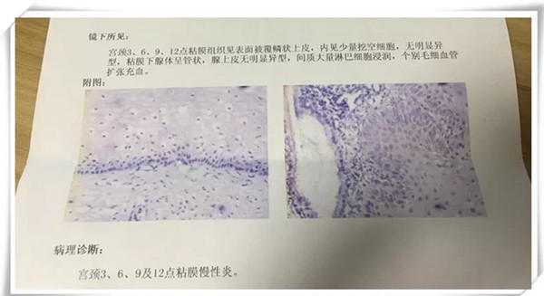 患者发现hpv,28岁感染hpv58