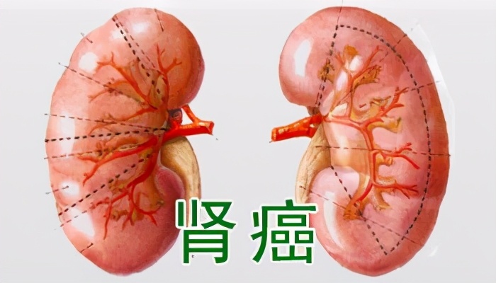 1厘米肾结石有事情吗,肾结石一个1.2一个1.6可以碎石吗