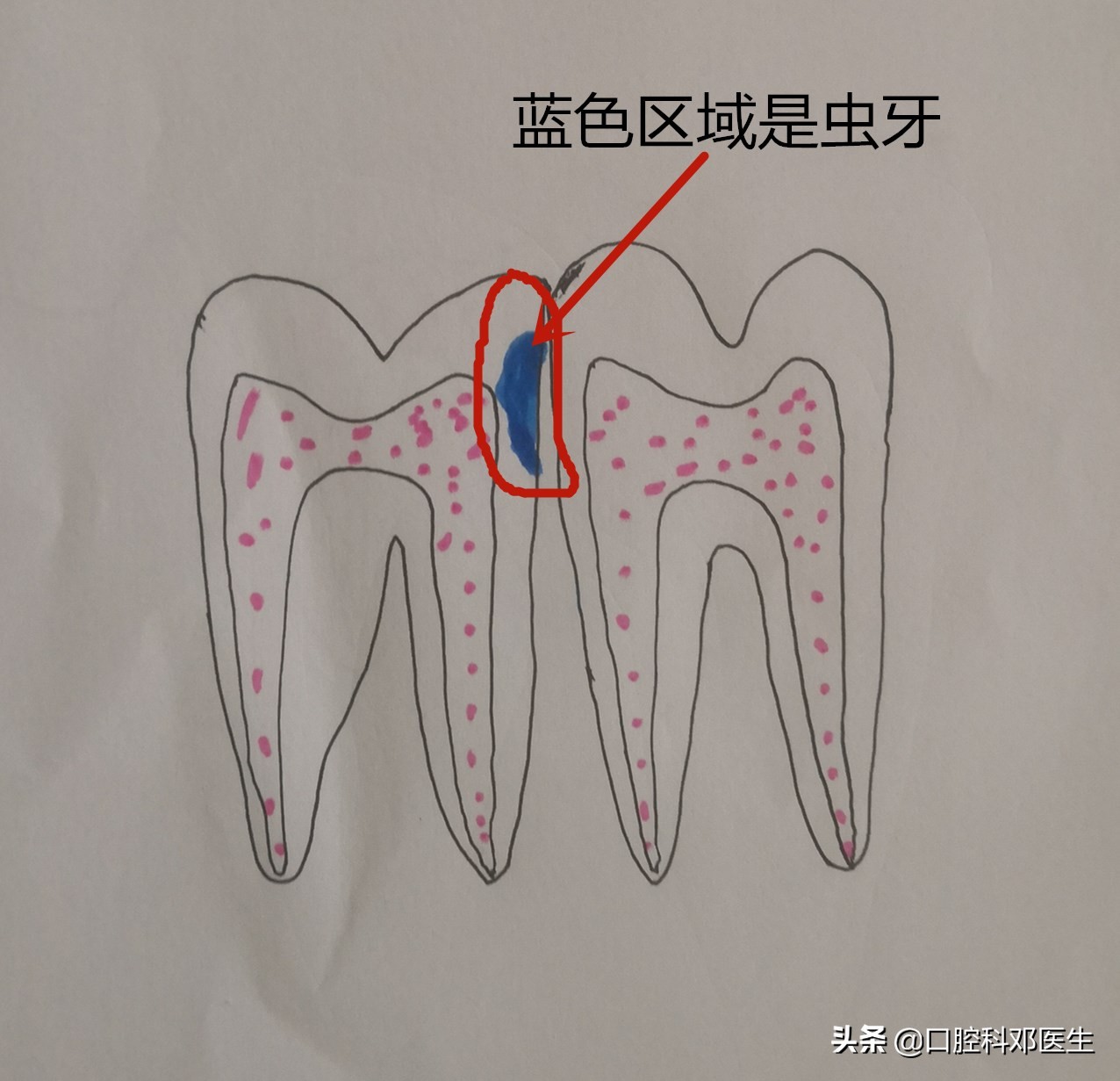 虫牙补牙方法有几种,虫洞露牙补牙的正确方法