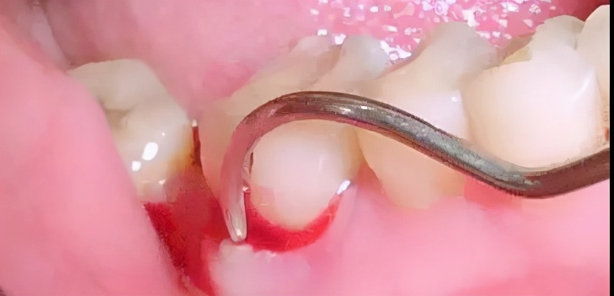 洗牙后牙龈一直出血用什么药止血,洗牙后出血凝结成血块包住了牙齿