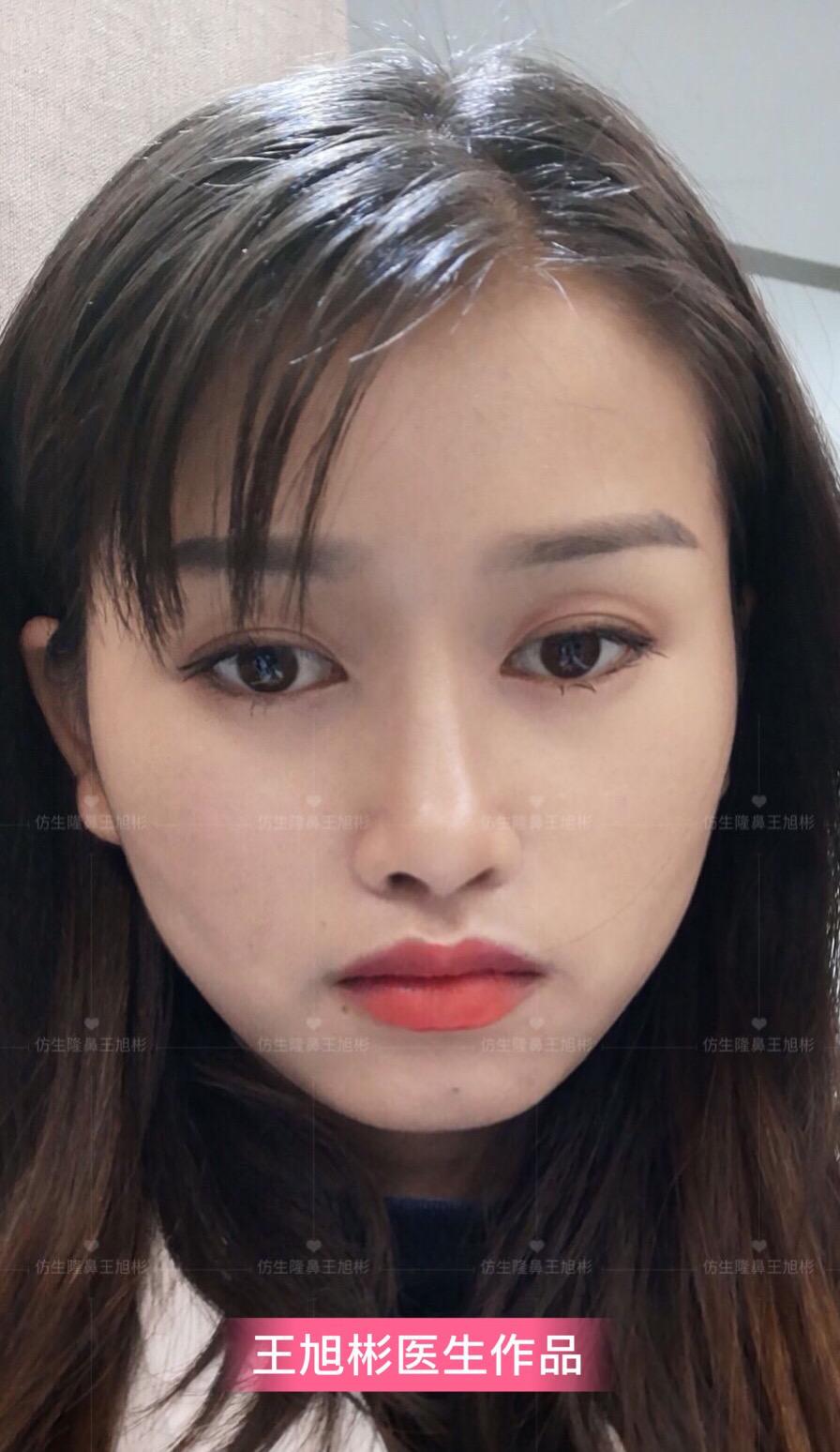 山根低鼻头大隆鼻,鼻根很低的隆鼻后的效果