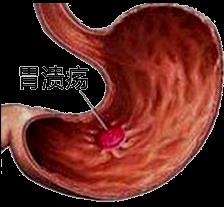 抗血小板药物停多久可以手术,抗血小板治疗药物