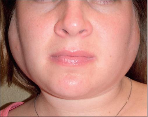 干燥综合征是什么样的症状,干燥综合征是什么样的