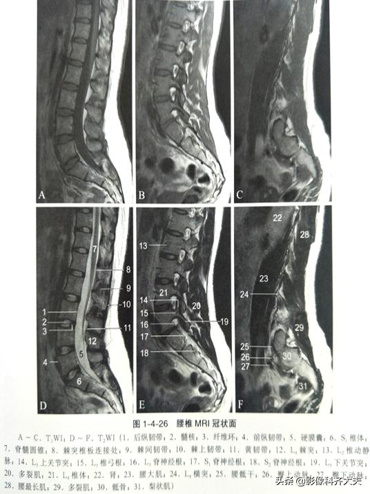 腰椎间盘突出最好的影像诊断方法,腰椎间盘突出的影像学检查