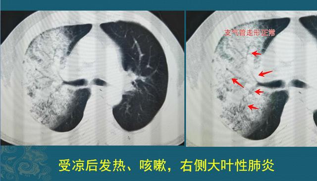 肺里咳出的痰对身体有害吗,从肺里咳出痰带血丝