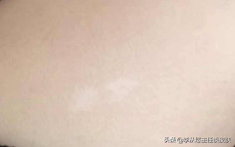 身上有几块白斑能被确诊白癜风,身上白色斑块怎么排除白癜风