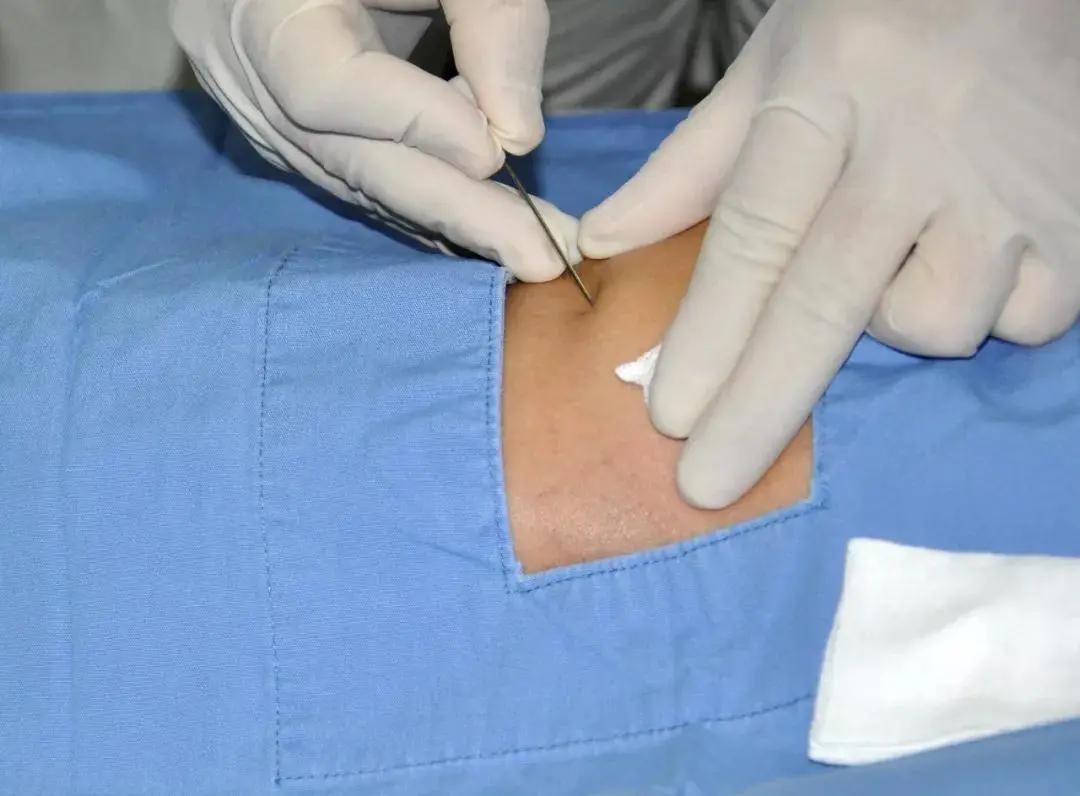 偏头痛太痛苦了,被偏头痛折磨得苦不堪言