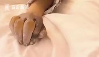 校园扫雪女孩手冻伤,13岁女孩扫雪被冻伤后来截肢了吗