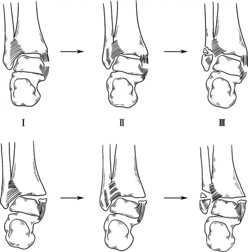 骨折闭合复位髓内钉内固定术,骨折闭合复位