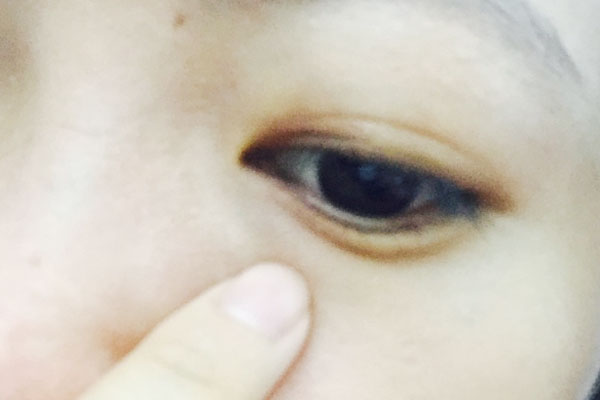 眼部周围长了小痘痘该怎么去除,眼部出现小颗粒痘是怎么回事