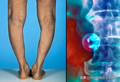 骨刺与骨性关节炎疼痛有什么区别,关节炎骨刺是怎么造成的