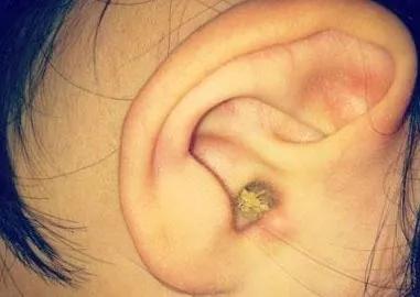 耳屎的颜色一般是什么,耳屎颜色有哪些