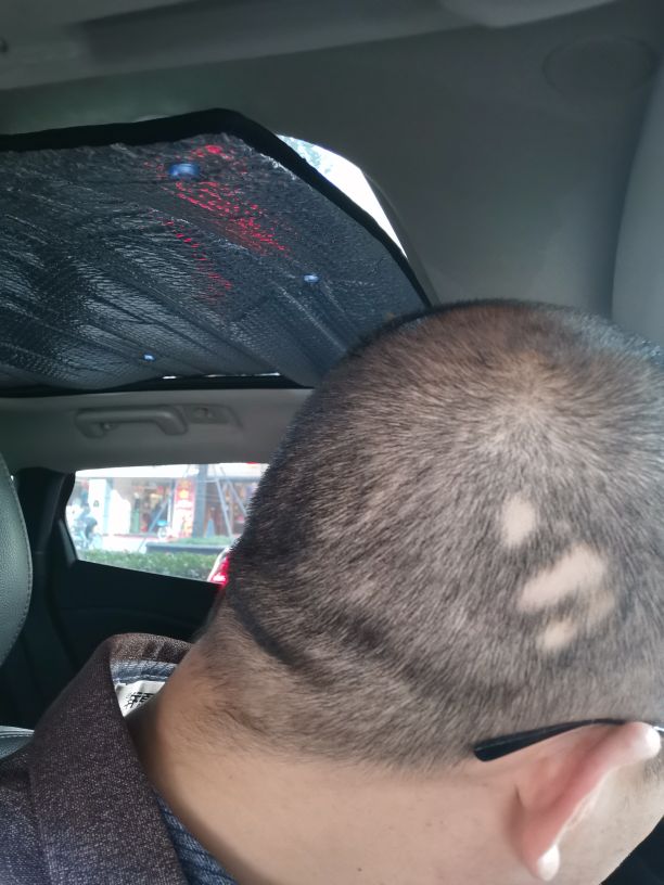 发现斑秃刚好又开始掉头发怎么办,突然发现斑秃怎么治疗