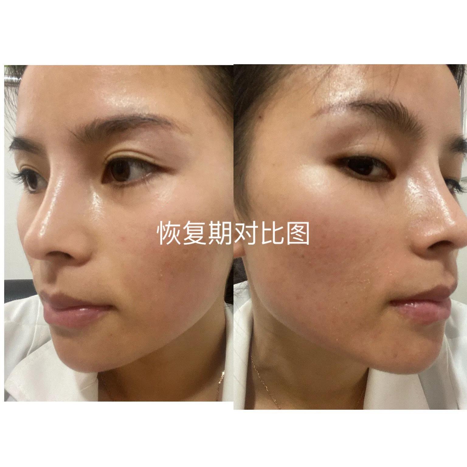 30天快速消痘印,30天祛痘效果最好的方法