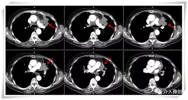 肺转移瘤消融能达到根治效果吗,肺转移瘤中医治疗