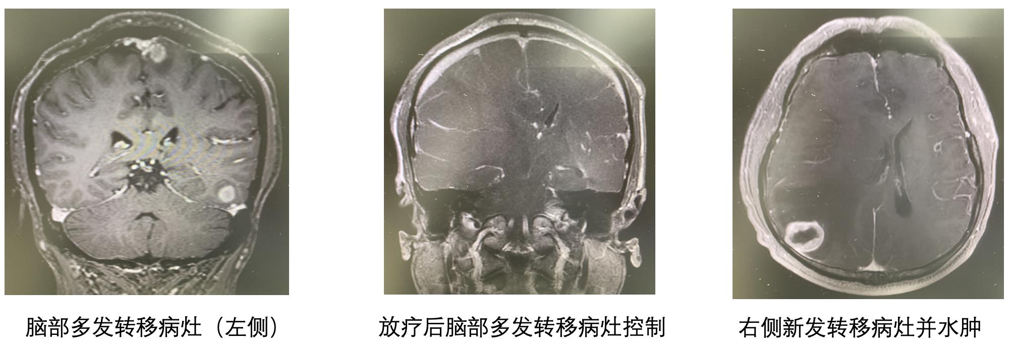 黑色素瘤早期切除后转移到脑部,黑色素瘤转移到肝上怎么办