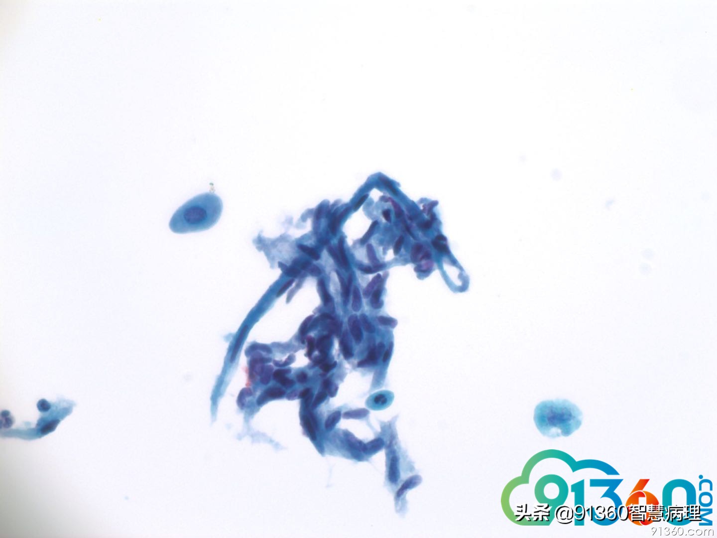 宫颈病理tct是什么检查,tct出现ascus会是宫颈癌吗