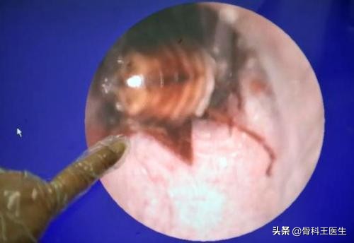 为什么会把异物塞进尿道,为什么会有人往尿道里塞异物