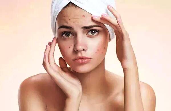 化妆后脸上过敏怎么办,脸过敏严重红肿爆皮怎么办