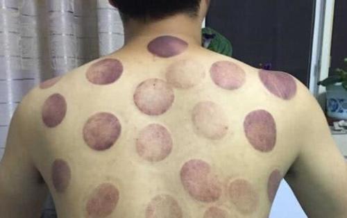 拔罐黑是有瘀血吗,拔罐要怎么才能更好拔出黑印