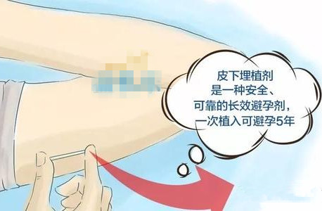 生了二胎才能用避孕产品,二胎生完了用什么方法避孕最好呢