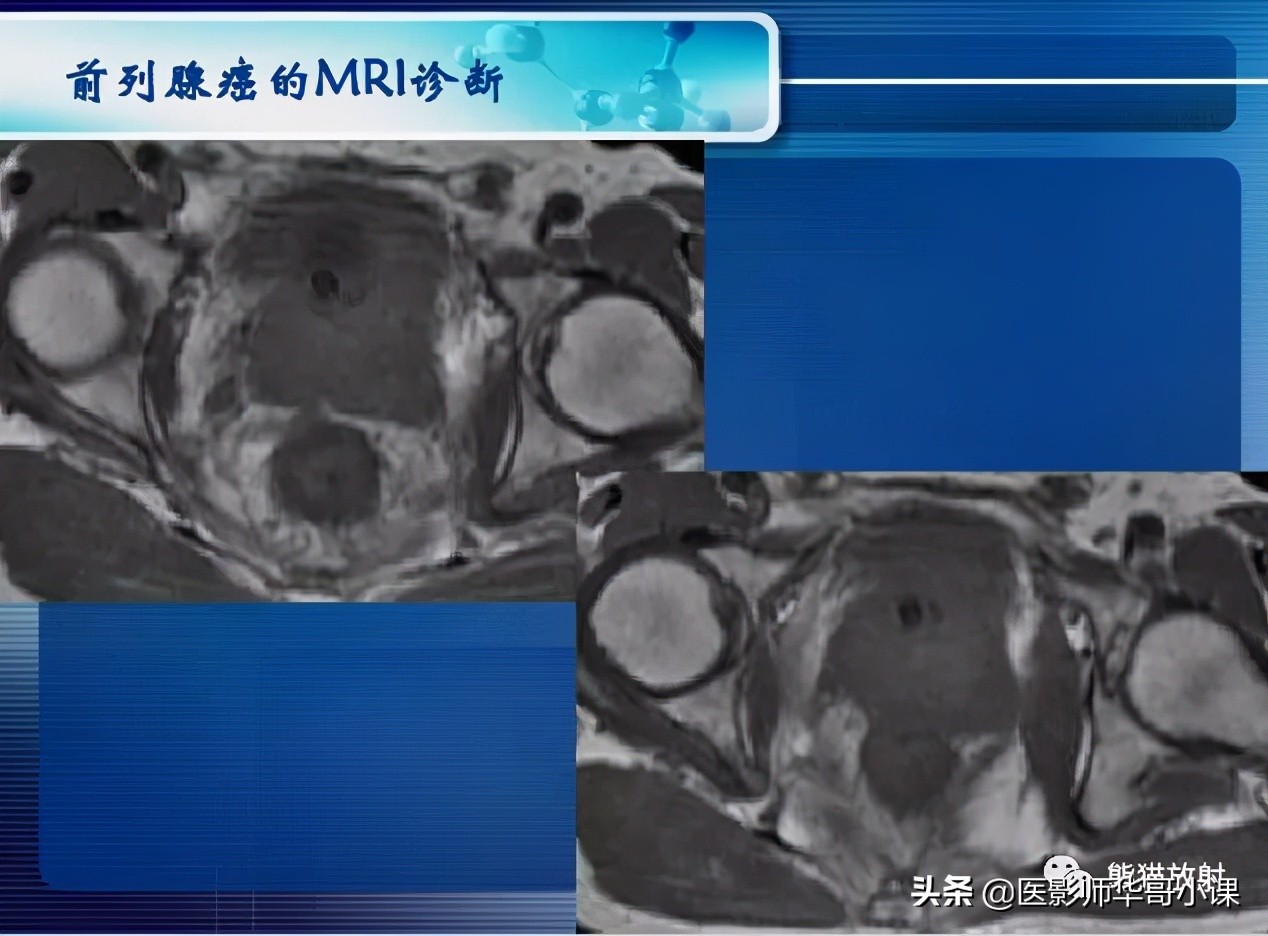 前列腺磁共振影像解剖,前列腺mri正常诊断报告模板