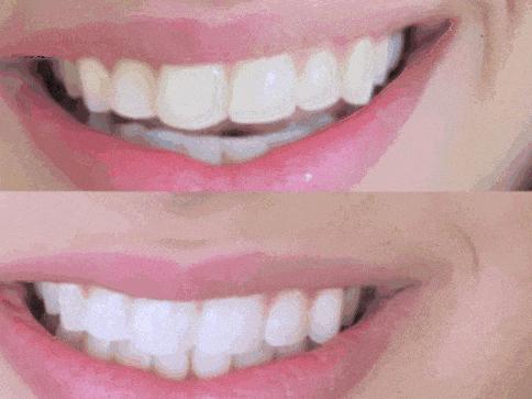 刷牙怎么刷能立刻从黄牙变成白牙,刷牙白牙小妙招