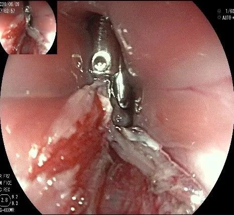贲门处见隆起性病变,贲门高级别瘤变esd术后不能吃什么
