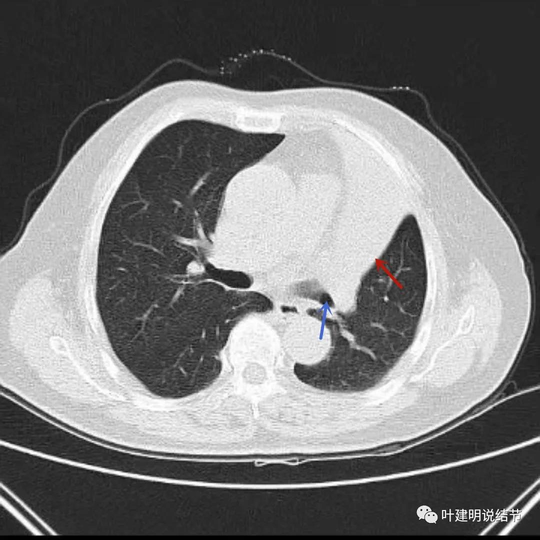 高龄肺癌靶向治疗效果,高龄老人肺癌早期适合放疗吗