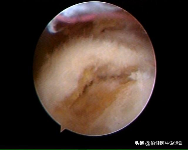 肩峰撞击综合征怎么办,游泳肩的治疗