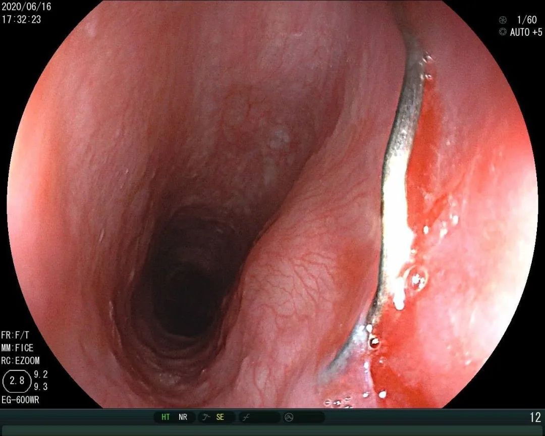 食堂吃到针头,饭菜吃进喉咙的时候感觉有点抵触