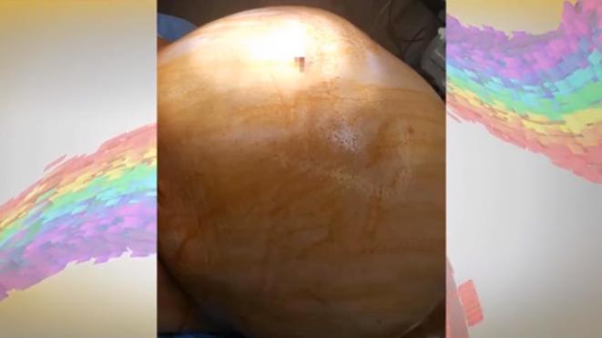 女子怀孕37周肚子巨大无比刨宫产取出25斤囊肿孩子只有5斤4两