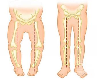 小宝宝腿不直是什么原因,小宝宝腿合不拢正常吗