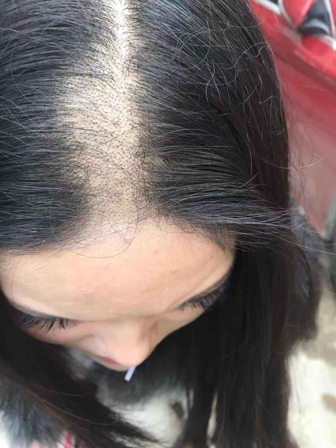 女子称入住酒店一觉醒来头秃一块酒店：无人进入房间