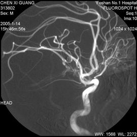 造影剂恶心持续多久,造影后造影剂没有及时排出后遗症