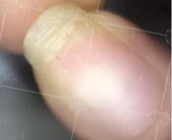 美甲会不会导致灰指甲,灰指甲脱甲液致癌