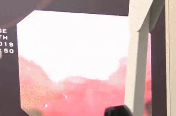 扁桃体发炎与扁桃体癌的区别,扁桃体瘤和扁桃体癌的区别