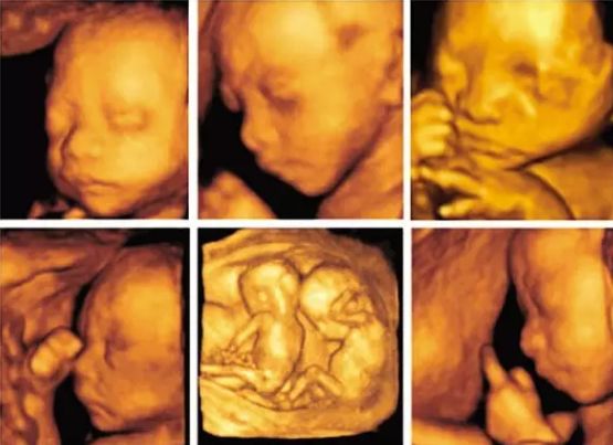 产检小孩唇腭裂是为什么,发现胎儿唇裂孕期补救办法